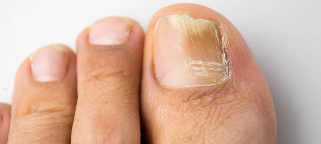 Types of Toenail Fungus