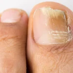 Types of Toenail Fungus