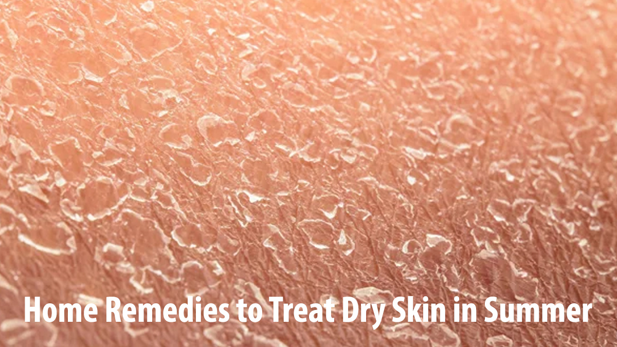 Home Remedies to Treat Dry Skin in Summer