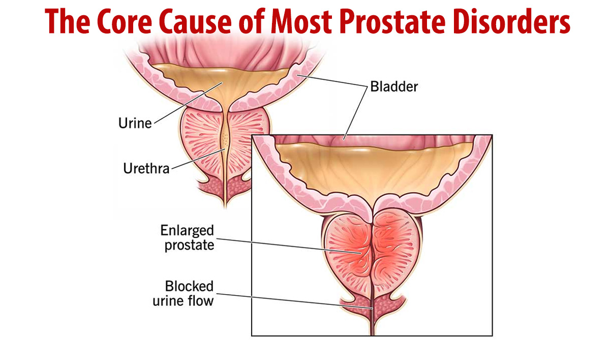 The Core Cause of Most Prostate Disorders