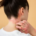 9 Home Remedies for Fungal Infections