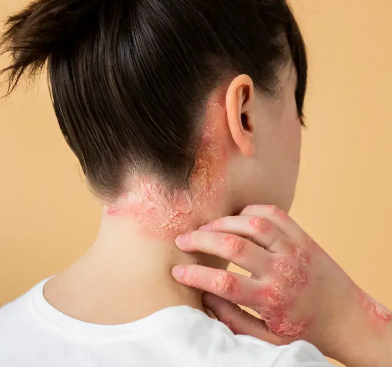 9 Home Remedies for Fungal Infections