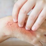 Can You Detox the Body to Get Rid of a Fungus?