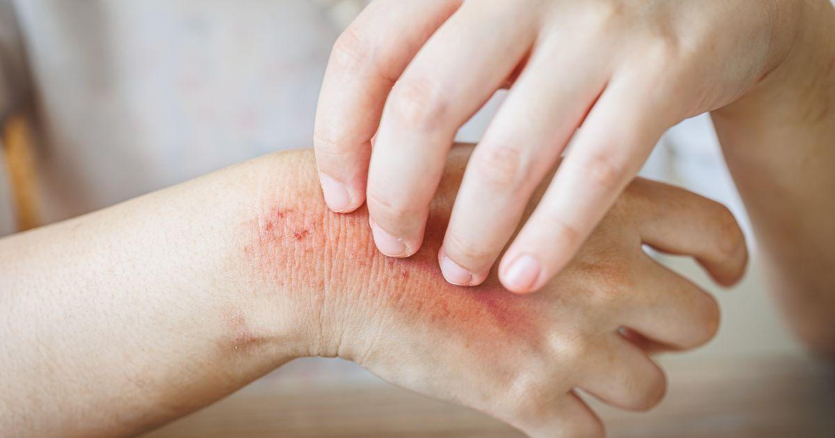 Can You Detox the Body to Get Rid of a Fungus?