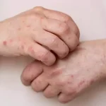 How to Kill Fungus on Skin