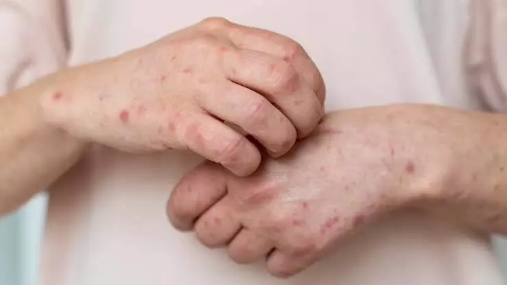 How to Kill Fungus on Skin