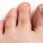 How to Stop Toenail Fungal Infections