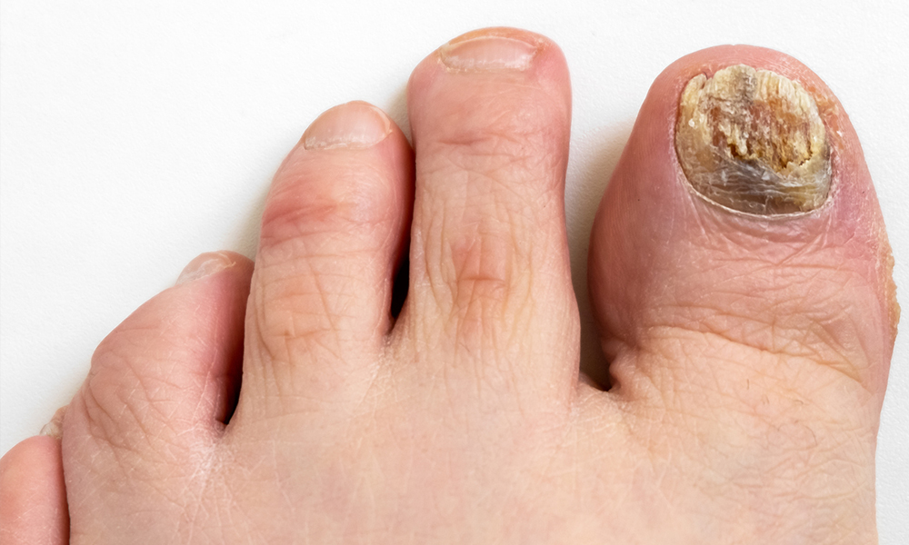 How to Stop Toenail Fungal Infections
