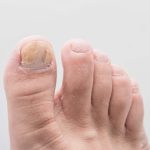 Nail fungus – Symptoms and causes