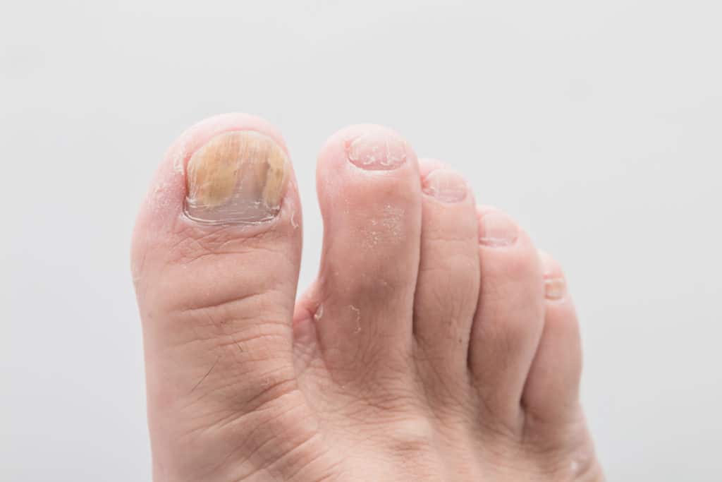Nail fungus - Symptoms and causes