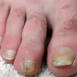 What Causes Toenail Fungus?