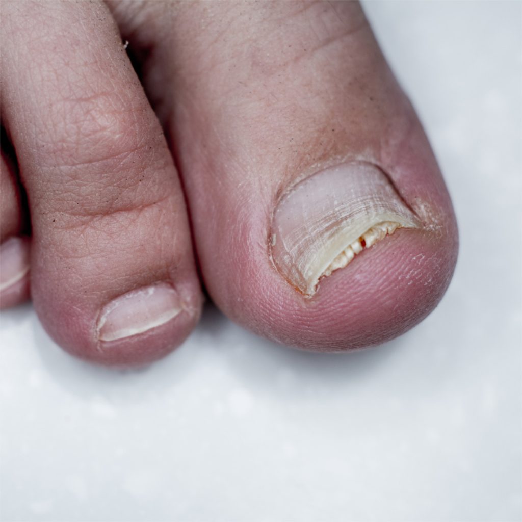What Causes a Pincer Toenail?