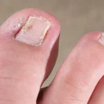 What Causes a Toenail to Turn Black?