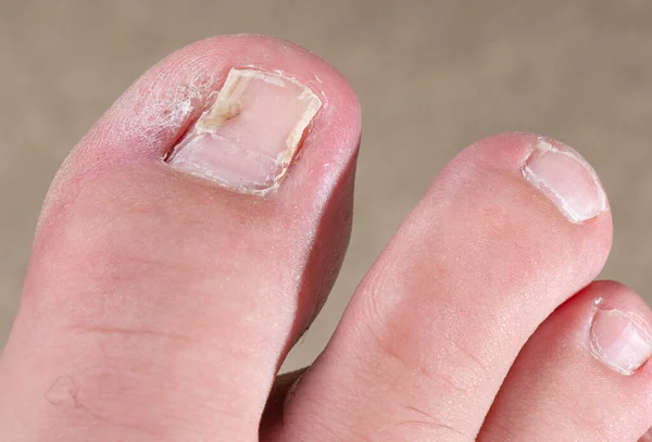 What Causes a Toenail to Turn Black?