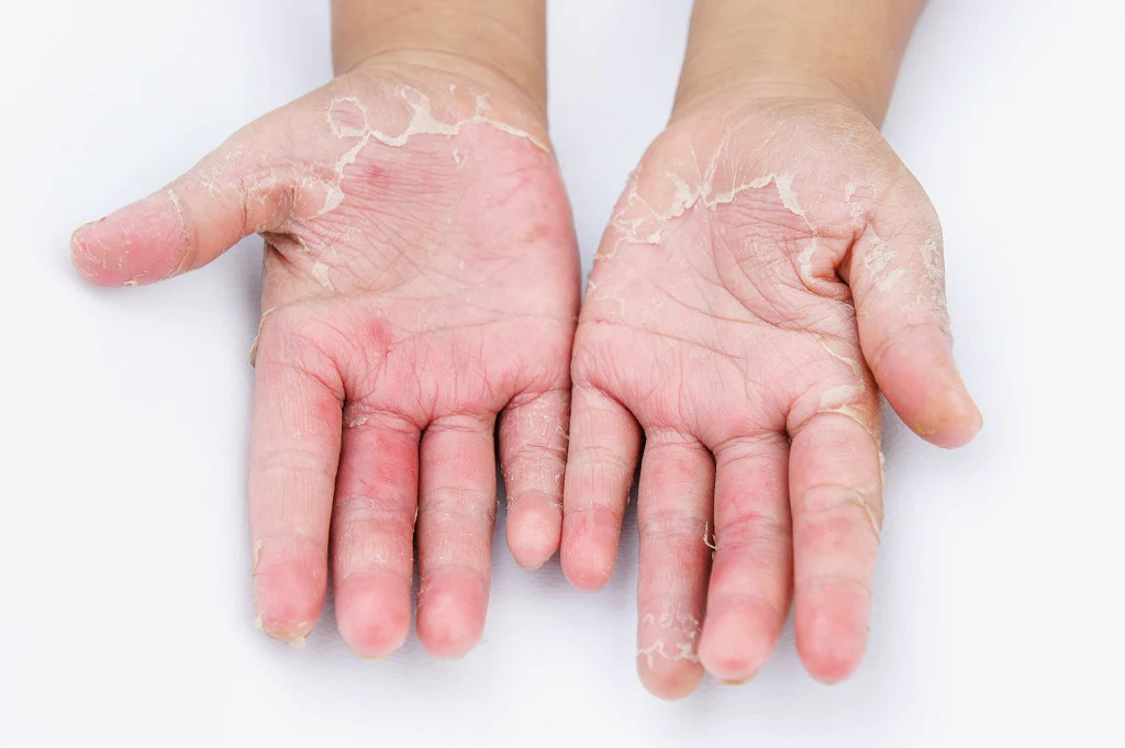 What Herbs Kill Fungus In The Body?