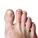 What Is the Difference Between Nail Psoriasis and Nail Fungus?