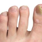 Why Thick Toenails Happen And How To Get Rid of Them