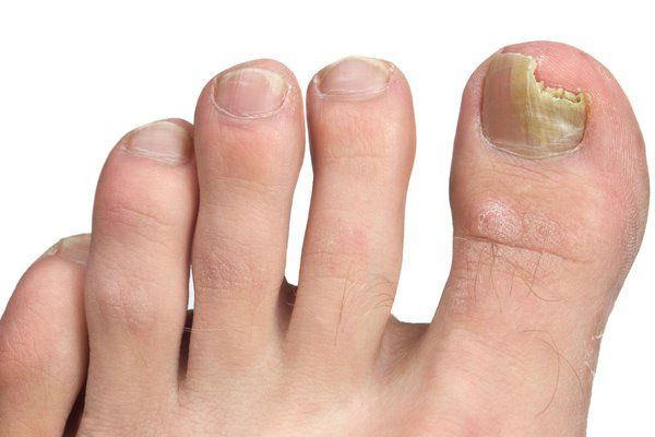 Why Thick Toenails Happen And How To Get Rid of Them